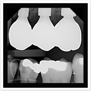 Beautifully Shaped Implant Crowns