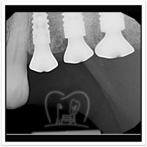 Implant Placement