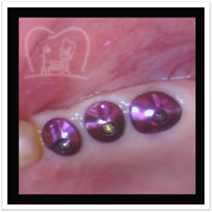 Custom Healing Abutments