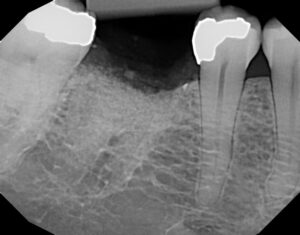 Bone Graft